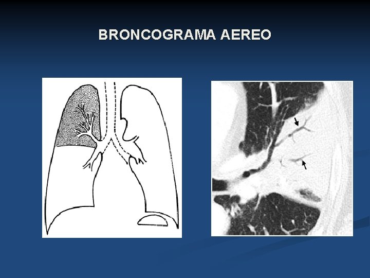 BRONCOGRAMA AEREO 