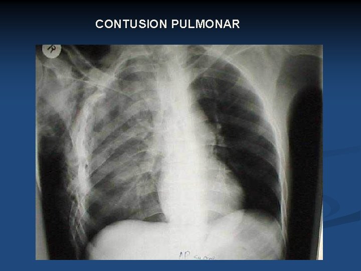 CONTUSION PULMONAR 