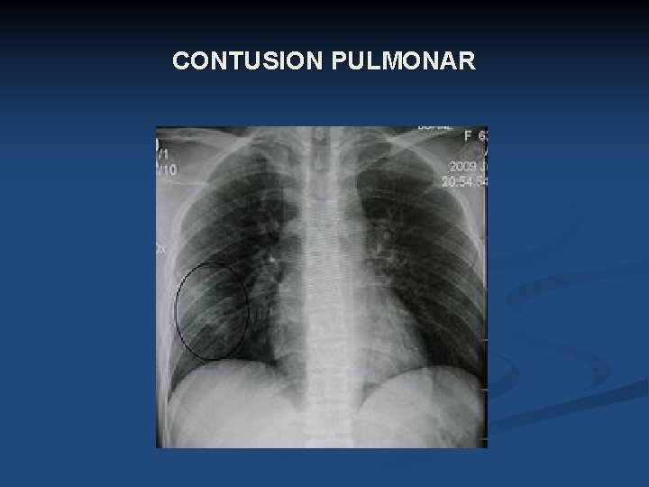 CONTUSION PULMONAR 