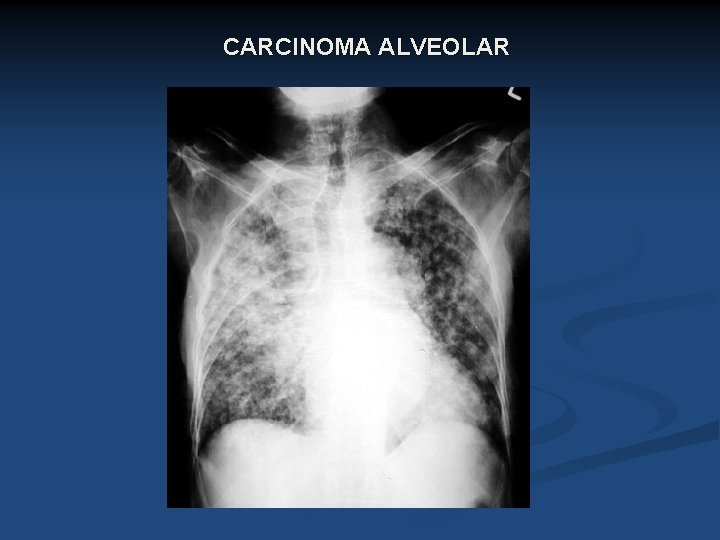 CARCINOMA ALVEOLAR 