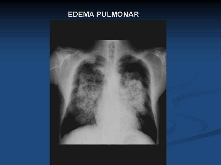 EDEMA PULMONAR 