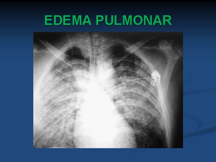 EDEMA PULMONAR 