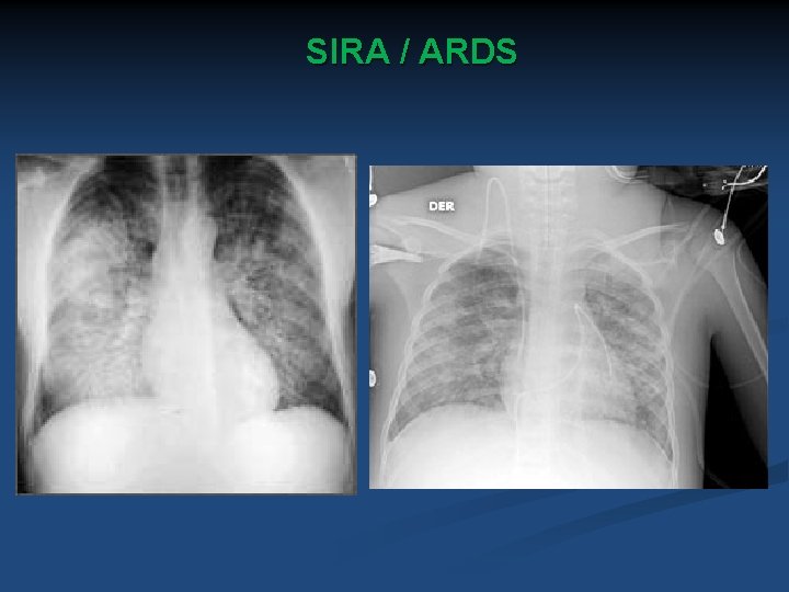 SIRA / ARDS 