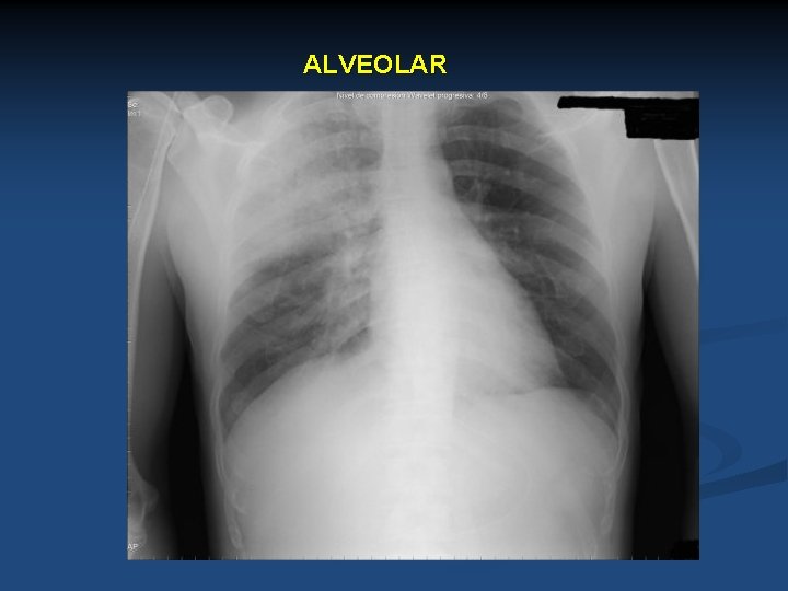 ALVEOLAR 