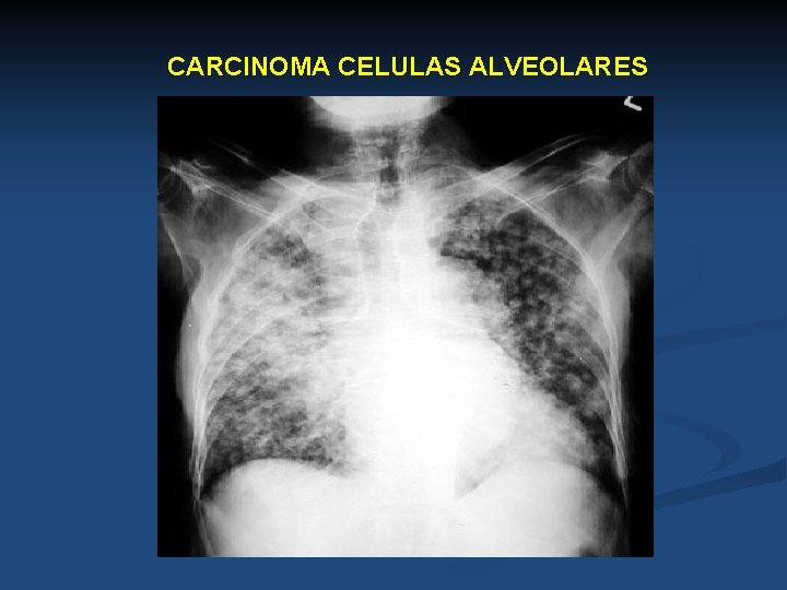 CARCINOMA CELULAS ALVEOLARES 