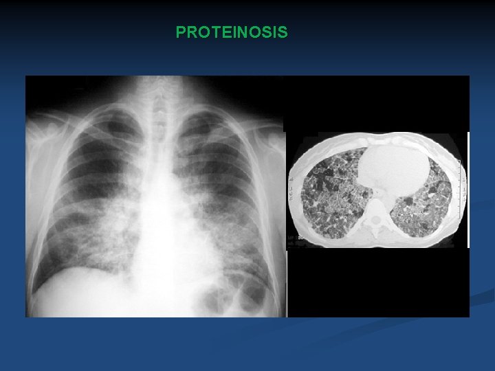 PROTEINOSIS 