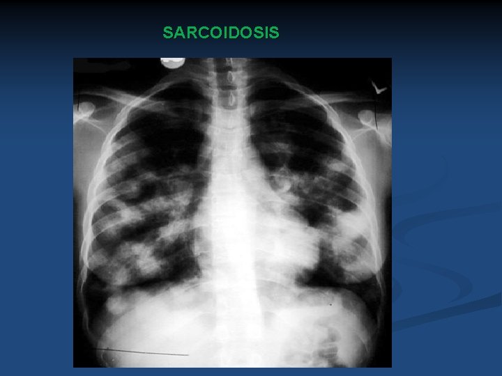 SARCOIDOSIS 