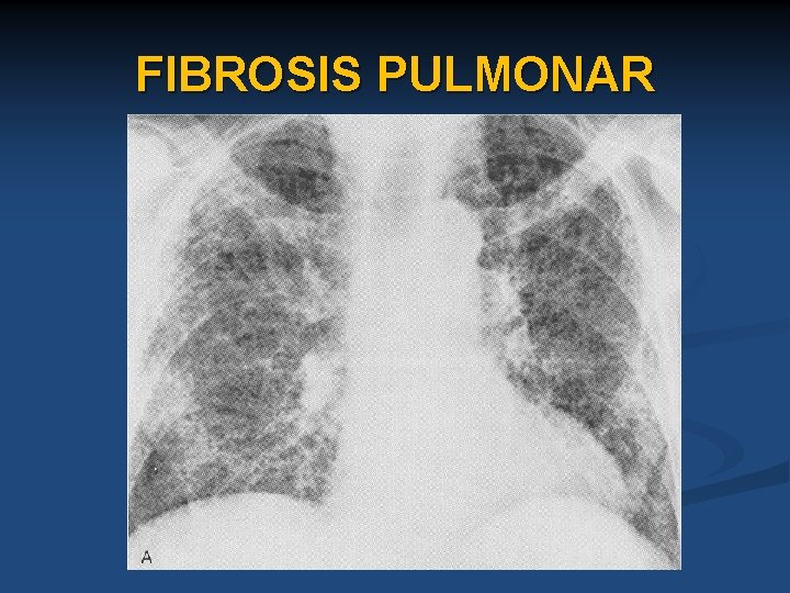 FIBROSIS PULMONAR 