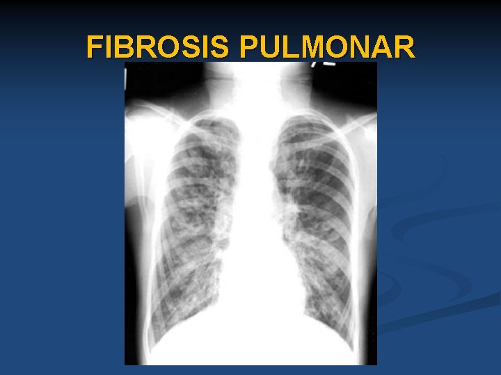 FIBROSIS PULMONAR 