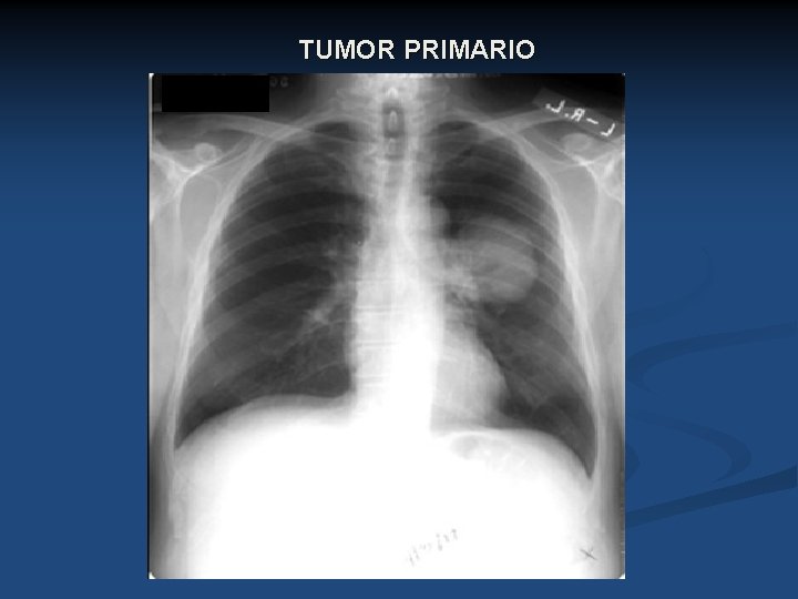 TUMOR PRIMARIO 