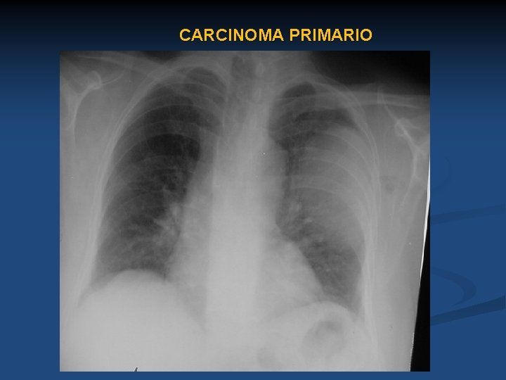 CARCINOMA PRIMARIO 