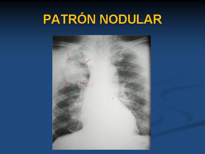 PATRÓN NODULAR 