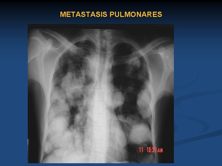 METASTASIS PULMONARES 