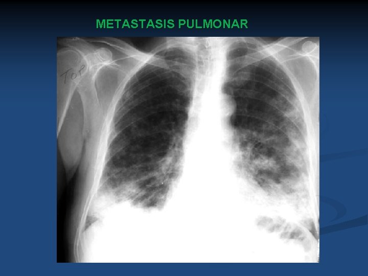 METASTASIS PULMONAR 