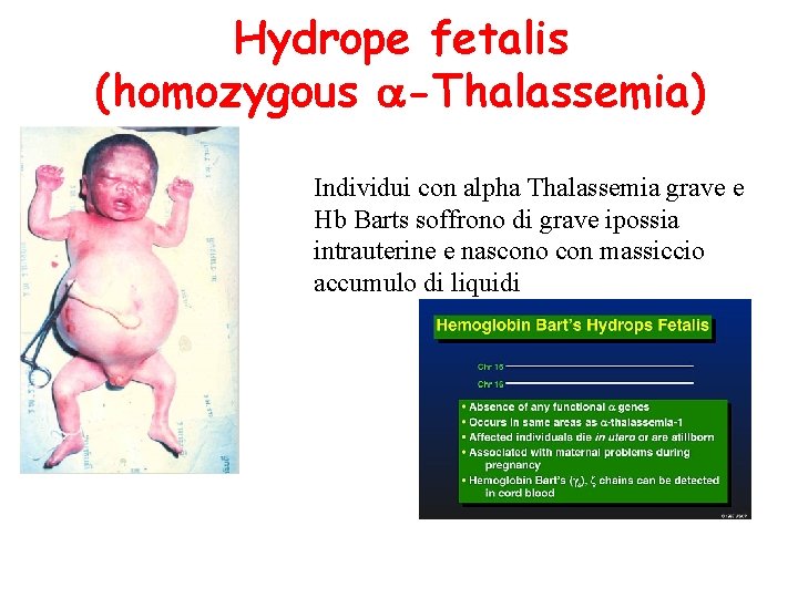 Hydrope fetalis (homozygous -Thalassemia) Individui con alpha Thalassemia grave e Hb Barts soffrono di