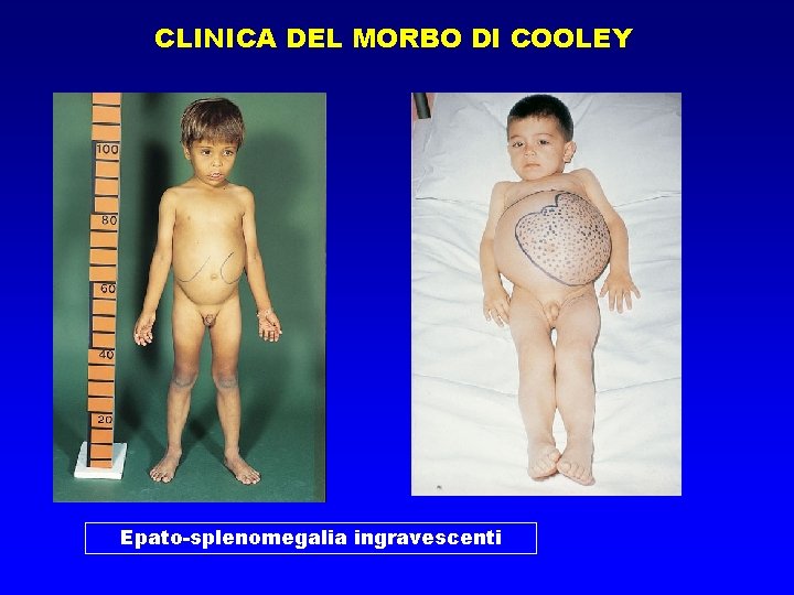 CLINICA DEL MORBO DI COOLEY Epato-splenomegalia ingravescenti 