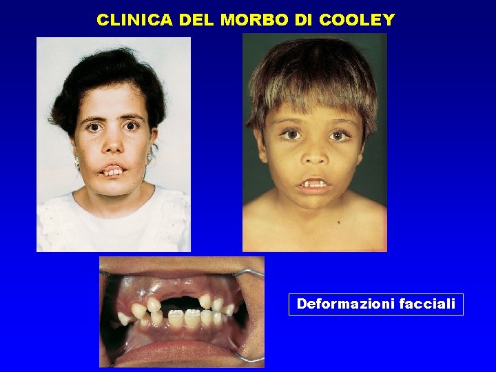 CLINICA DEL MORBO DI COOLEY Deformazioni facciali 