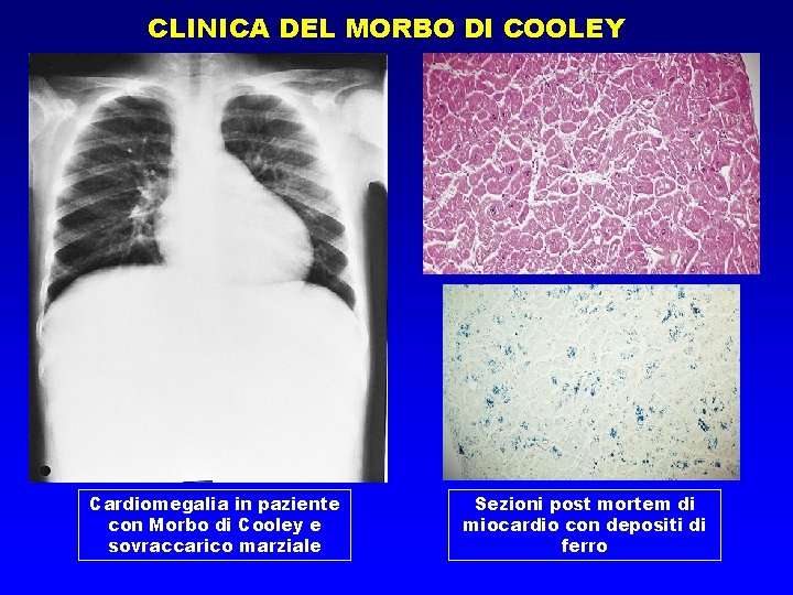 CLINICA DEL MORBO DI COOLEY Cardiomegalia in paziente con Morbo di Cooley e sovraccarico