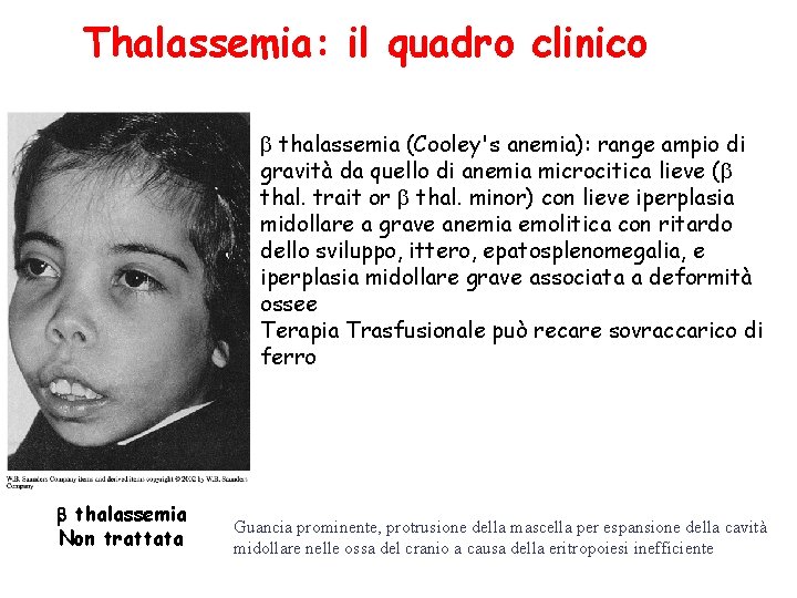 Thalassemia: il quadro clinico thalassemia (Cooley's anemia): range ampio di gravità da quello di