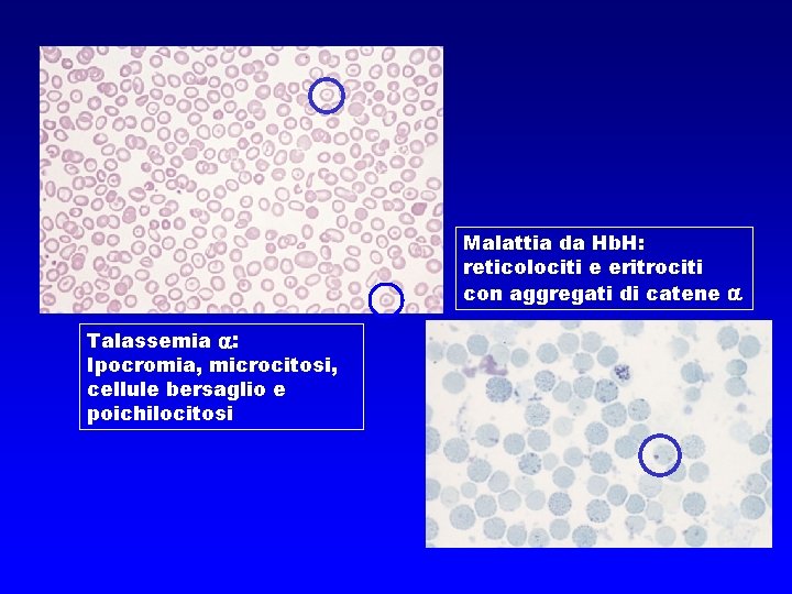 Malattia da Hb. H: reticolociti e eritrociti con aggregati di catene Talassemia : Ipocromia,