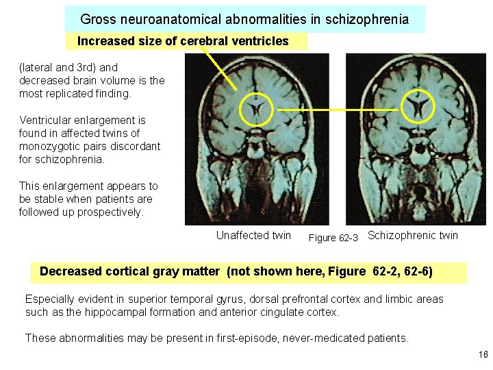 Gross neuroanatomical abnormalities in schizophrenia Increased size of cerebral ventricles (lateral and 3 rd)