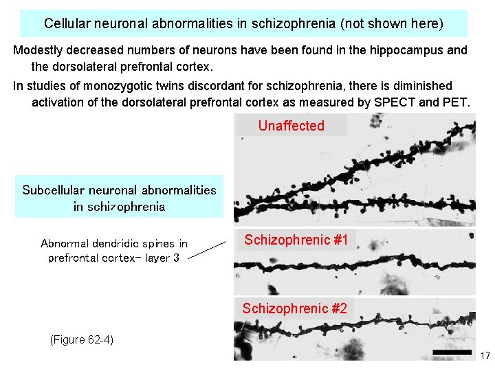 Cellular neuronal abnormalities in schizophrenia (not shown here) Modestly decreased numbers of neurons have