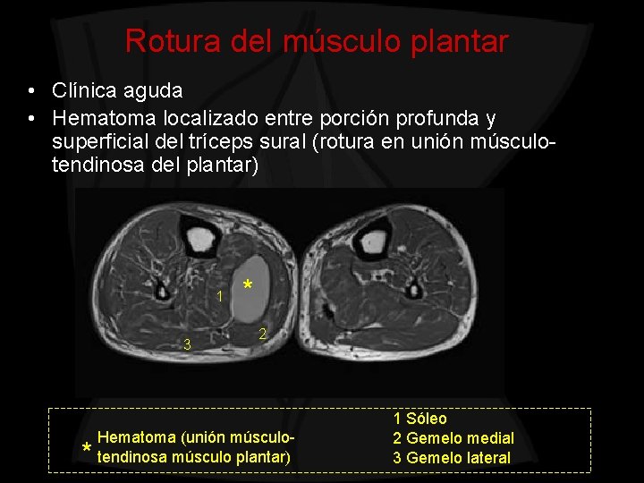 Rotura del músculo plantar • Clínica aguda • Hematoma localizado entre porción profunda y