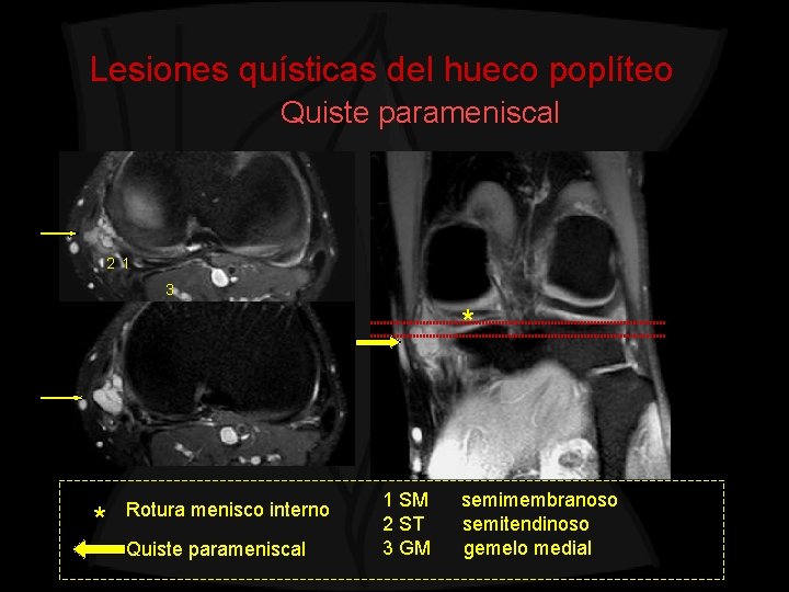 Lesiones quísticas del hueco poplíteo Quiste parameniscal 2 1 3 * * Rotura menisco