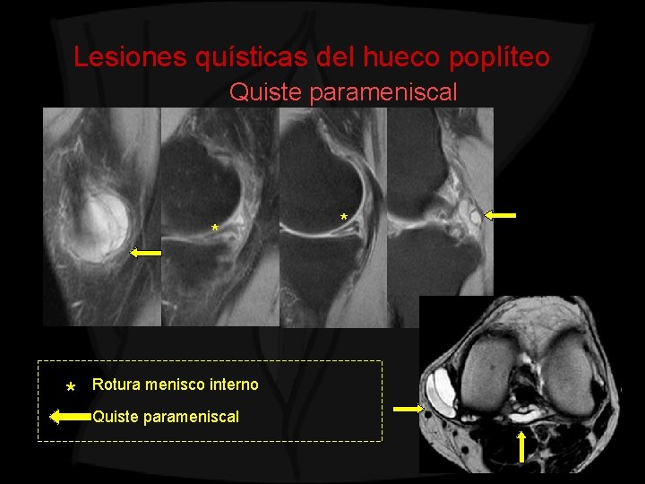 Lesiones quísticas del hueco poplíteo Quiste parameniscal * * Rotura menisco interno Quiste parameniscal