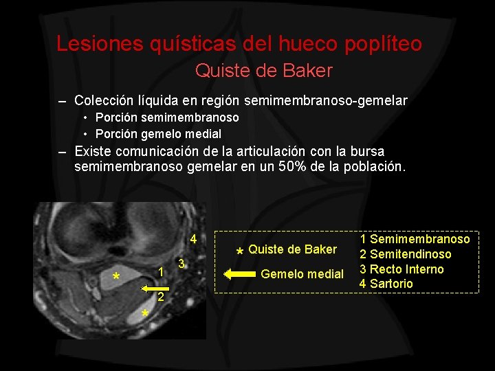 Lesiones quísticas del hueco poplíteo Quiste de Baker – Colección líquida en región semimembranoso-gemelar