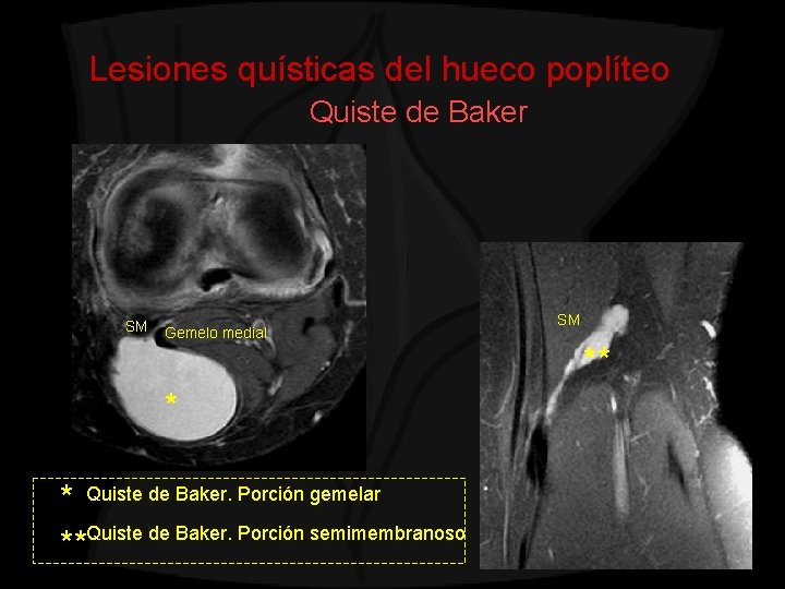 Lesiones quísticas del hueco poplíteo Quiste de Baker SM Gemelo medial * * Quiste