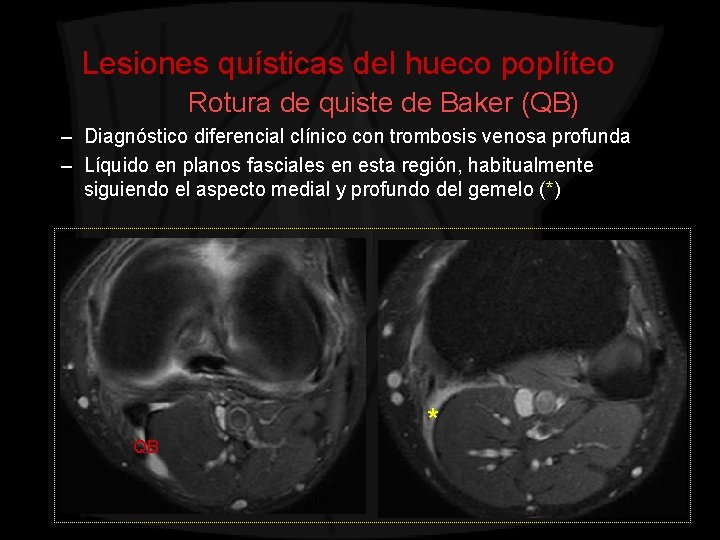 Lesiones quísticas del hueco poplíteo Rotura de quiste de Baker (QB) – Diagnóstico diferencial