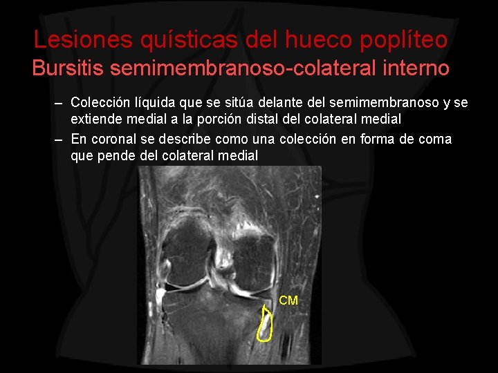 Lesiones quísticas del hueco poplíteo Bursitis semimembranoso-colateral interno – Colección líquida que se sitúa