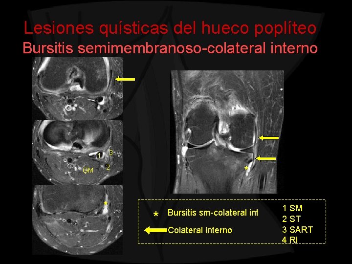 Lesiones quísticas del hueco poplíteo Bursitis semimembranoso-colateral interno 3 1 GM 2 * *