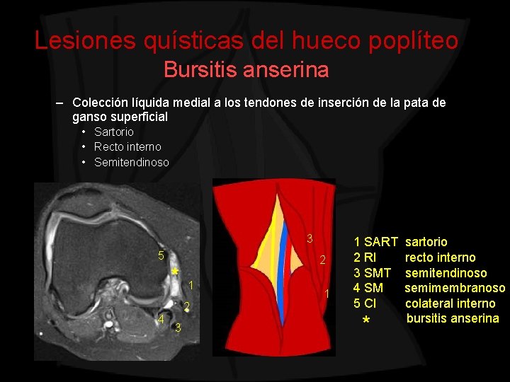 Lesiones quísticas del hueco poplíteo Bursitis anserina – Colección líquida medial a los tendones