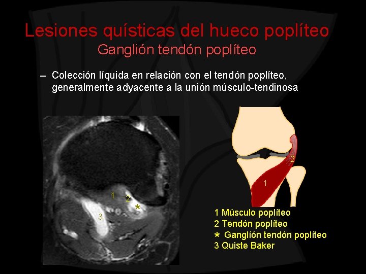 Lesiones quísticas del hueco poplíteo Ganglión tendón poplíteo – Colección líquida en relación con