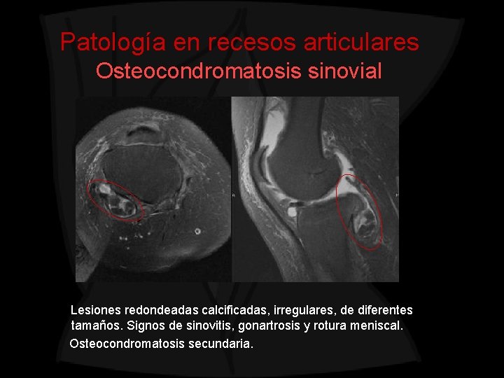 Patología en recesos articulares Osteocondromatosis sinovial Lesiones redondeadas calcificadas, irregulares, de diferentes tamaños. Signos