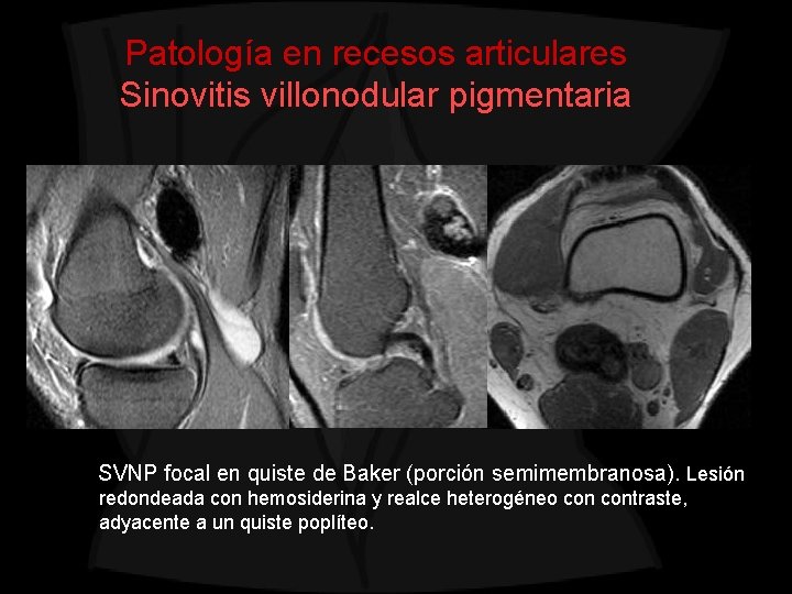 Patología en recesos articulares Sinovitis villonodular pigmentaria SVNP focal en quiste de Baker (porción