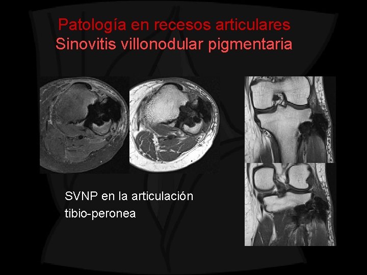 Patología en recesos articulares Sinovitis villonodular pigmentaria SVNP en la articulación tibio-peronea 