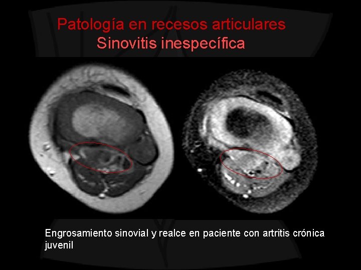 Patología en recesos articulares Sinovitis inespecífica Engrosamiento sinovial y realce en paciente con artritis