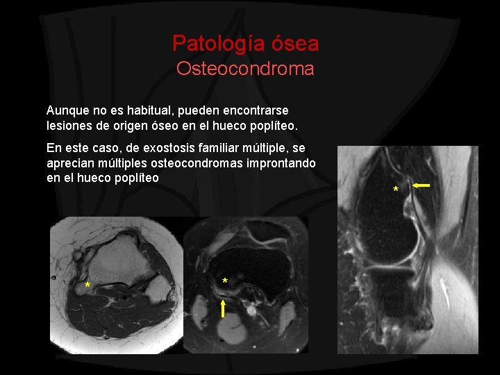 Patología ósea Osteocondroma Aunque no es habitual, pueden encontrarse lesiones de origen óseo en