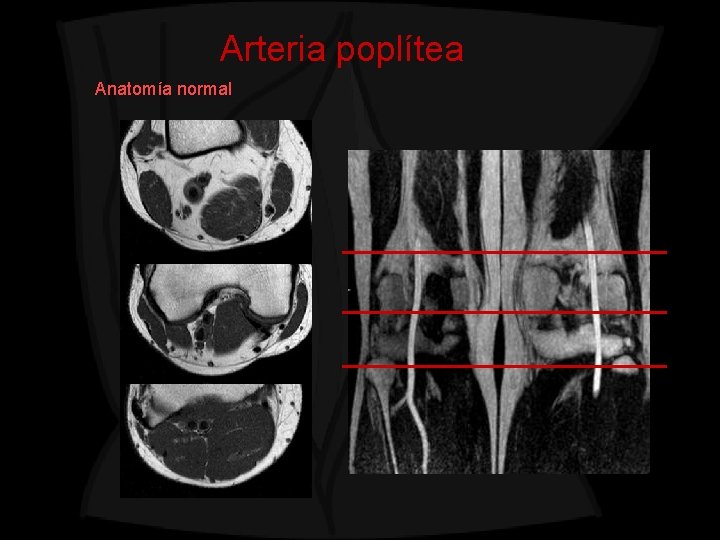 Arteria poplítea Anatomía normal 