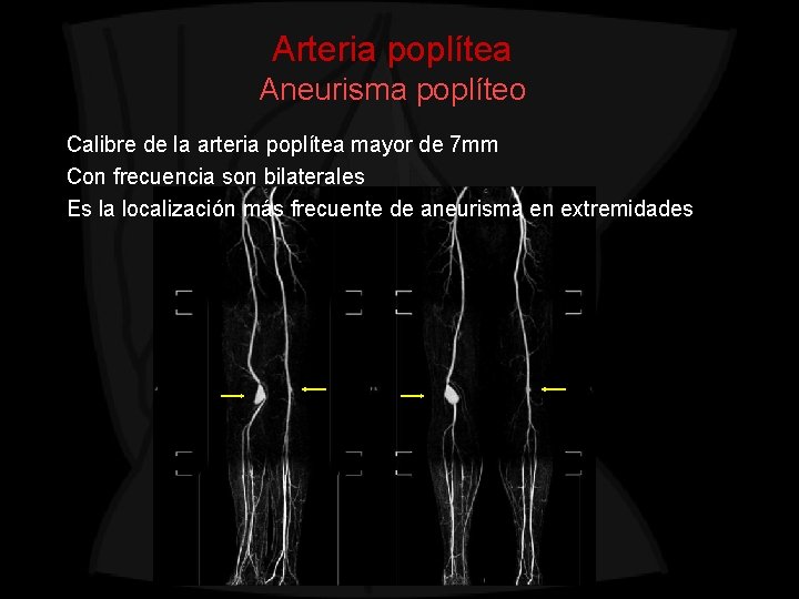 Arteria poplítea Aneurisma poplíteo Calibre de la arteria poplítea mayor de 7 mm Con