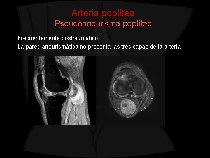 Arteria poplítea Pseudoaneurisma poplíteo Frecuentemente postraumático La pared aneurismática no presenta las tres capas