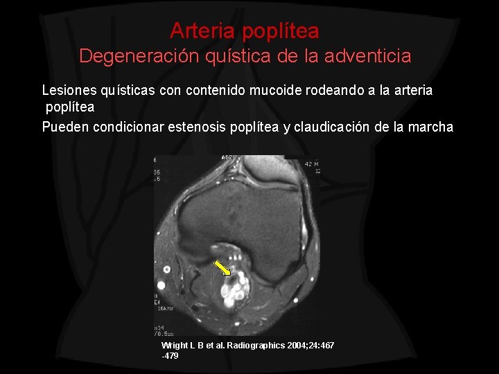 Arteria poplítea Degeneración quística de la adventicia Lesiones quísticas contenido mucoide rodeando a la