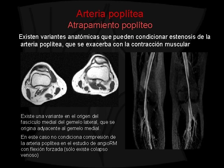 Arteria poplítea Atrapamiento poplíteo Existen variantes anatómicas que pueden condicionar estenosis de la arteria