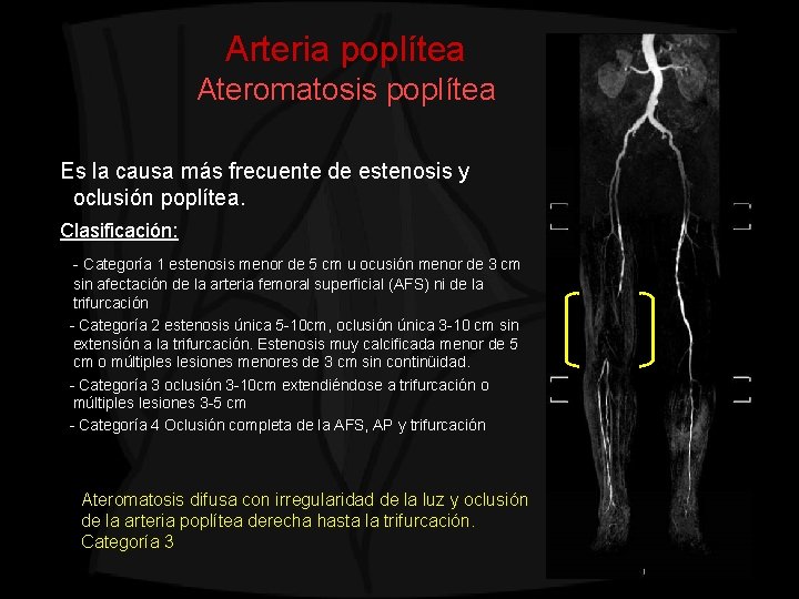 Arteria poplítea Ateromatosis poplítea Es la causa más frecuente de estenosis y oclusión poplítea.
