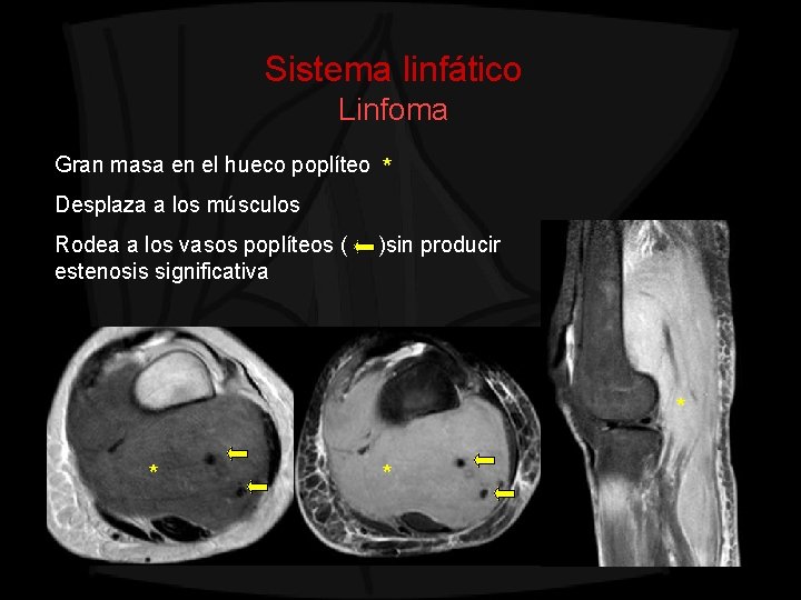 Sistema linfático Linfoma Gran masa en el hueco poplíteo * Desplaza a los músculos