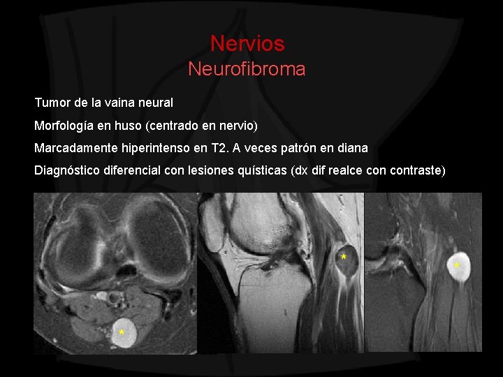 Nervios Neurofibroma Tumor de la vaina neural Morfología en huso (centrado en nervio) Marcadamente