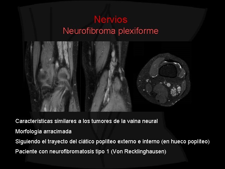 Nervios Neurofibroma plexiforme Características similares a los tumores de la vaina neural Morfología arracimada